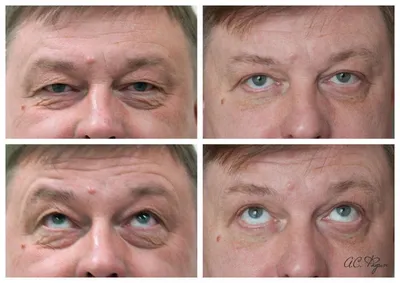 Мешки под глазами, грыжи на стороне человека Пластический хирург считает  пациента до Blepharoplasty Стоковое Фото - изображение насчитывающей  здоровье, глаза: 169522918