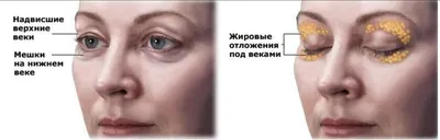 Почему возникают грыжи под глазами? «Ochkov.net»