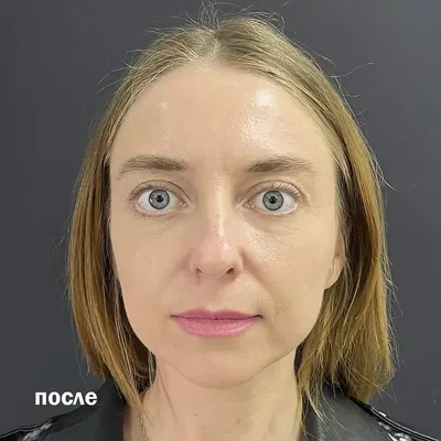 Инъекции липолитиков под глаза в Москве. Клиника Марины Рябус