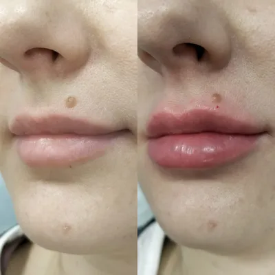 Dr.NinoMokshina - Коррекция сложных губ👄 ⠀ ❓Что такое сложные губы? ⠀  🔘это тонкие губы 🔘это губы «чайки» 🔘это губы с неправильным прикусом  🔘это губы, которые требуют рассасывания «старого» филлера 🔘это  ассиметричные губы (