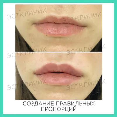 Коррекция губ - статьи о красоте от специалистов академии косметологии  Premium Aesthetics