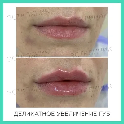 Осуществи свою мечту с @swclinic_ 🎁👄 Контурная пластика губ👇🏻 Показания  к процедуре: -ассиметрия верхней или нижней губы; -коррекция мор… |  Instagram