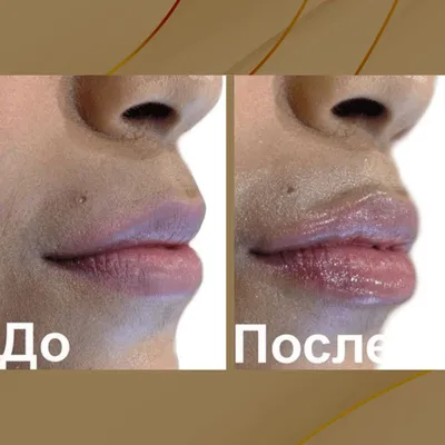 Только посмотрите, как меняется и гармонизируется лицо после увеличения губ?🙈⠀  ⠀ Задача процедуры, за счет максимально приближенной к… | Instagram