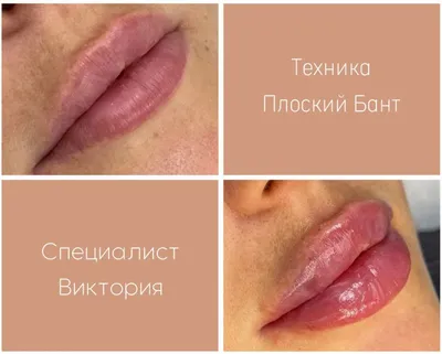 Поднять уголки рта. Ботокс — vzbeauty.ru