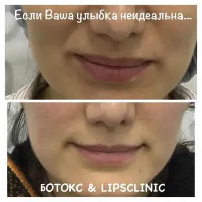 Увеличение губ гиалуроновой кислотой в Москве, цены в клинике Vitaura