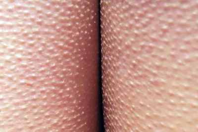 Гусиная кожа: как избавиться, убрать фолликулярный гиперкератоз лечить крем  в домашних условиях | Beauty Insider