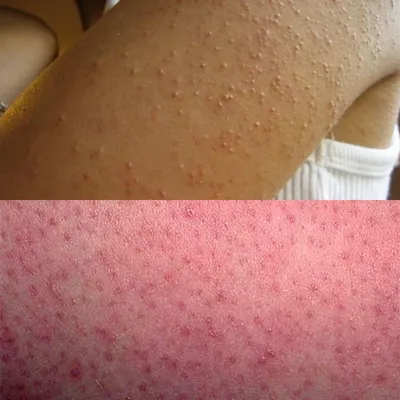 Гусиная кожа - фолликулярный кератоз | Пикабу