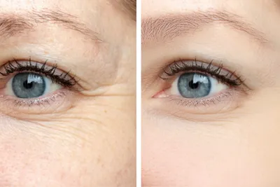 Как часто можно колоть ботокс вокруг глаз - Cosmetic-clinic