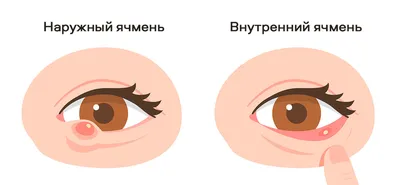 Не плюй в глаз: что такое ячмень и как его правильно лечить, чем опасна  народная медицина | О здоровье: с медицинского на русский | Дзен