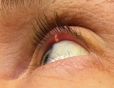 Почему на глазу появляется ячмень и что делать – объясняет врач-офтальмолог  — Здоровый образ жизни