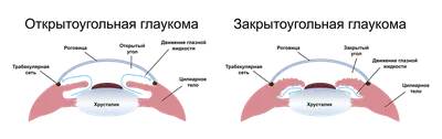 Глаукома: симптомы и лечение у взрослых - Причины возникновения и виды  глаукомы | Глаукома.ру