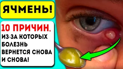 ЯЧМЕНЬ на глазу: как быстро ВЫЛЕЧИТЬ - YouTube