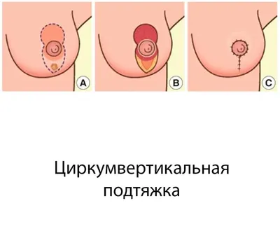 Виды подтяжки груди - Антон Выходцев - Пластический хирург