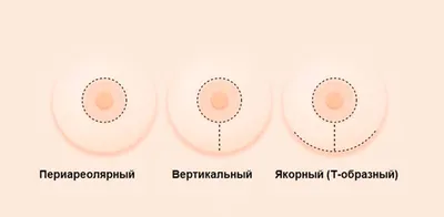 Подтяжка груди отзывы: за и против подтяжки груди.