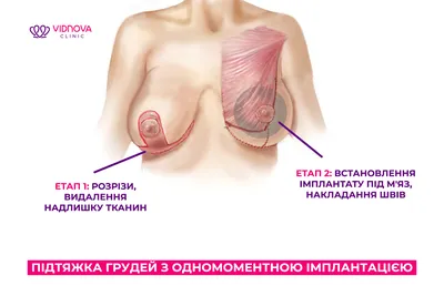 Подтяжка груди ▷ Мастопексия ▷ Подтяжка груди без имплантов в Киеве: цены и  отзывы