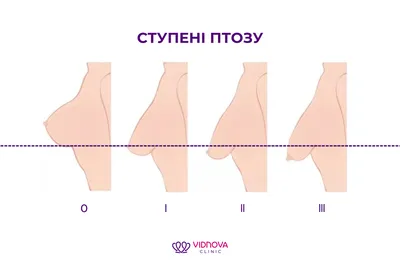 Подтяжка груди: цены от 197 200 руб. в Москве | Мастопексия в «Номосклиник»