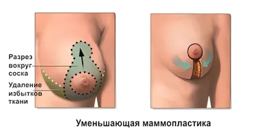 Якорная подтяжка груди - цена, фото до и после Т-образной мастопексии  молочных желез