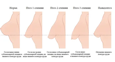 Мастопексия. Якорная подтяжка груди. Коррекция груди после родов и  лактации. Хирург Соколов А.А. - YouTube