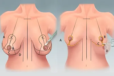 Подтяжка груди ▷ Мастопексия ▷ Подтяжка груди без имплантов в Киеве: цены и  отзывы