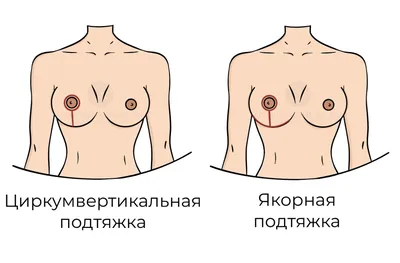 Мастопексия груди: цена операции в Москве, фото до и после