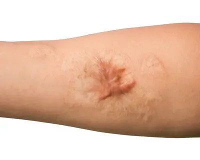 Лечение рубцов кожи после операции – лечение келлоидных рубцов в «Клинике  Хелена»