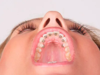 Язвы в небе - Вопрос стоматологу - 03 Онлайн