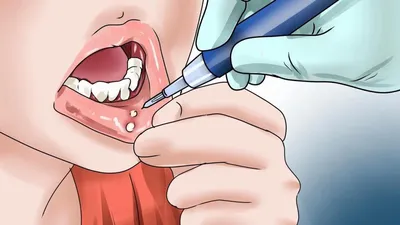 Белые язвочки во рту - причины и лечение