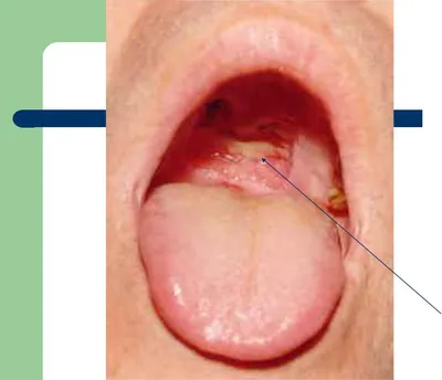 Язвы на нёбе и десне - Вопрос стоматологу - 03 Онлайн