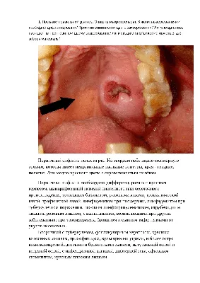 Фарингит: признаки, симптомы, лечение - МедКом