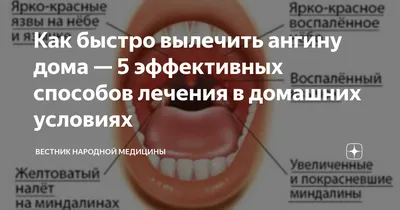 Афтозный стоматит – причины, симптомы, лечение в Москве – цены, отзывы в  стоматологических клиниках Зуб.ру