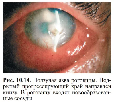 Рис. 10.14. Ползучая язва роговицы. Подрытый прогрессирующий край напр…