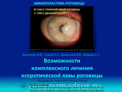 Сухой глаз Язва роговицы Бржеский В.В. с соавт | Энциклопедия офтальмологии