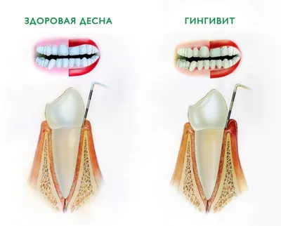 Лечение гингивита - Стоматология Дизайнер ваших улыбок