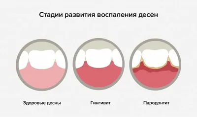 Гингивит → Пародонтит → Пародонтоз. Чем опасна эта триада?