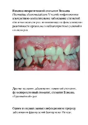 Лечение Гингивита: доступные цены в Москве | Стоматология «Улыбнись» на  Алексеевской и Шелепихе