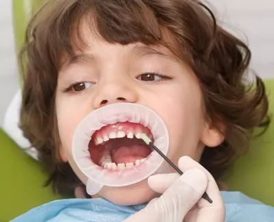 Гингивит у детей: причины возникновения и лечение – статьи детской  стоматологической клиники «Мартинка»
