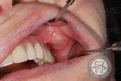 Воспаление десен: признаки, лечение. Чем снять воспаление десны около зуба