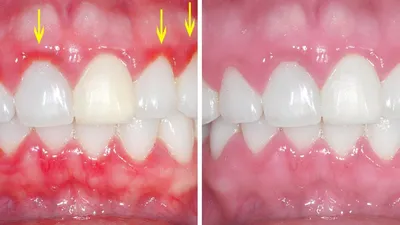 Язвенный гингивит - презентация онлайн
