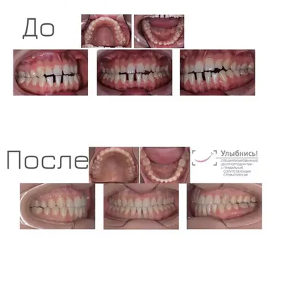 Гингивит у взрослых - стоимость услуги Пародонтология в стоматологии в  Киеве, Гингивит у взрослых - цена в стоматологии lipinskii.com.ua