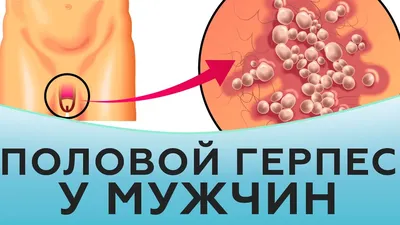 Баланит и баланопостит: симптомы, диагностика и лечение в клинике Universum  Clinic