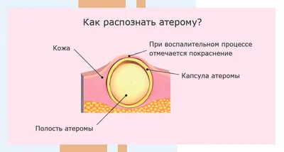 Баланит и баланопостит