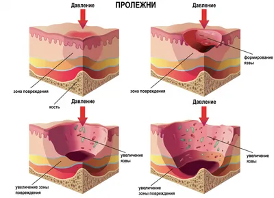 Половой герпес. Симптомы, лечение и профилактика