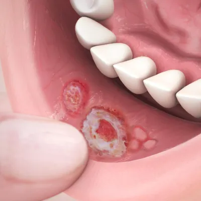 Стоматит: лечение, симптомы, виды, признаки у взрослых и детей