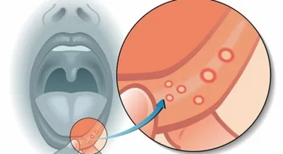 Язвы Во Рту На Языке 9 Фото Лечение Киев ЛюмиДент