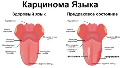 Белые язвочки во рту: 4 причины образования, 3 группы препаратов для лечения