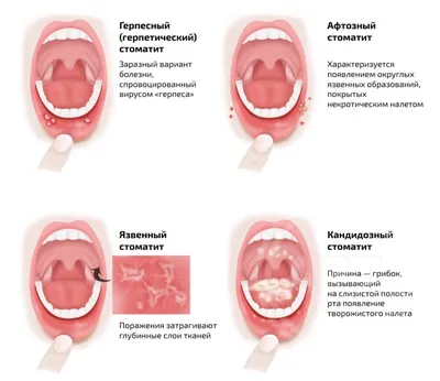 Афтозный стоматит – что это, лечение, виды, причины и симптомы