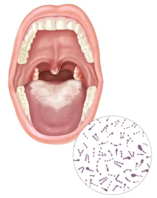 Что вызывает зуд во рту? Причины, симптомы и лечение — от аллергии до  дрожжевой инфекции - Все про аллергию
