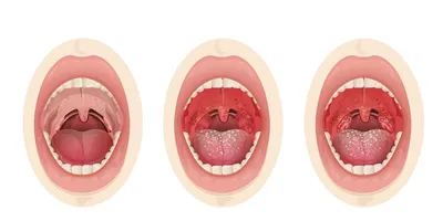Поражения слизистой оболочки рта при системной красной волчанке -  DENTALMAGAZINE.RU