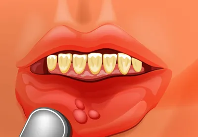 Лекарство от стоматита, препараты и средства для лечения стоматита во рту у  врослых