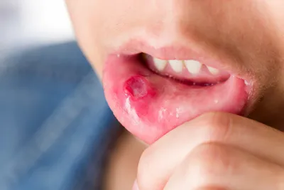 Проявления бактериальных инфекций в полости рта